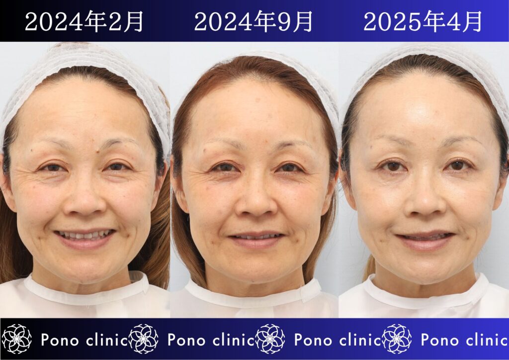 目の下のクマ治療、裏ミッドフェイスリフト®、PRPF®療法、50代の症例 (4)