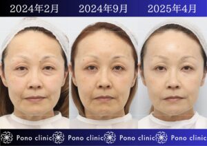 50代女性の症例、目の下のクマ、シワ治療、法令線治療 (1)