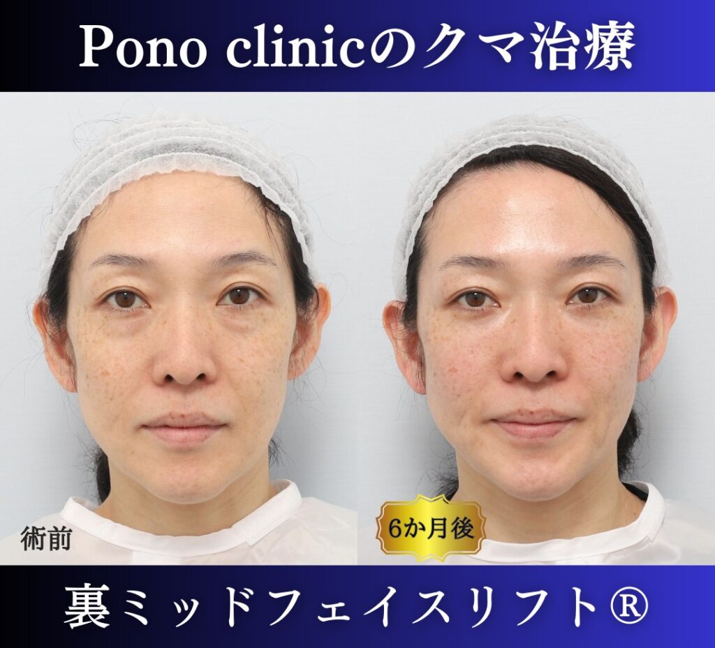40代女性の症例、目の下のクマ取り (7)