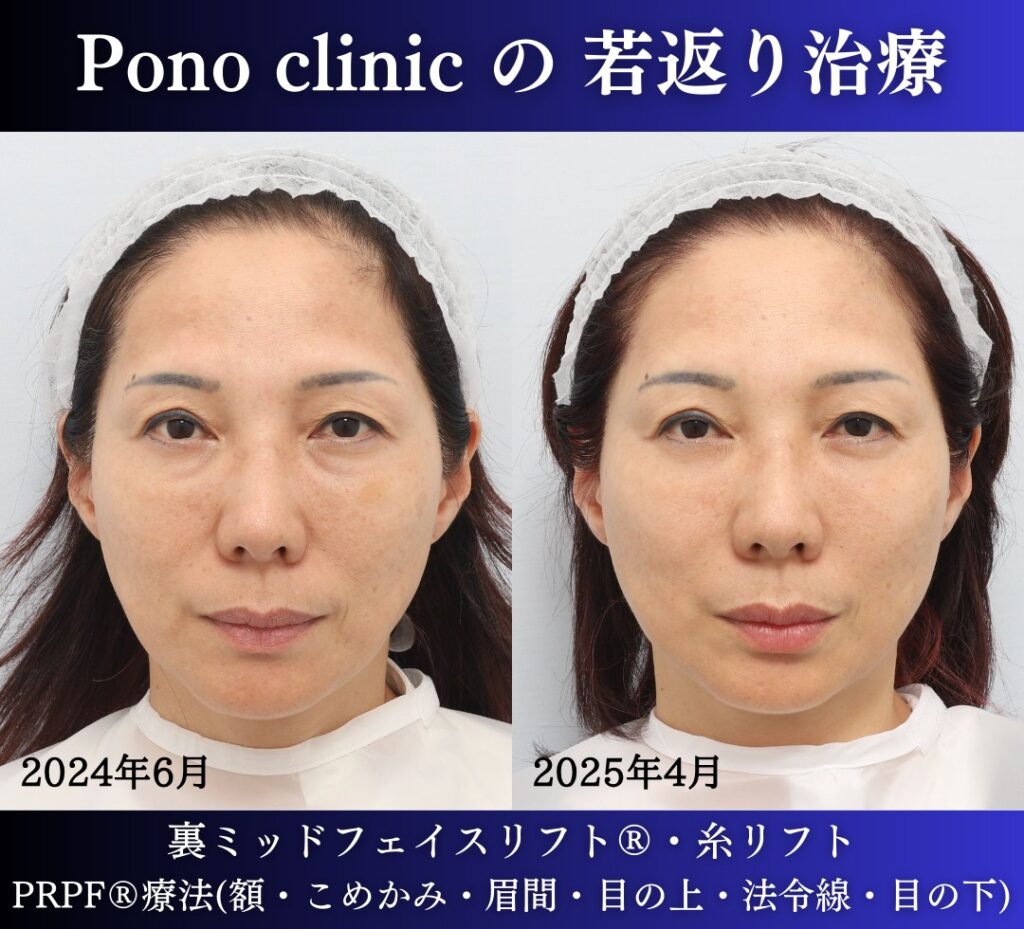 50代女性の症例、目の下のクマ、糸リフト、PRPF療法、若返り治療 (5)
