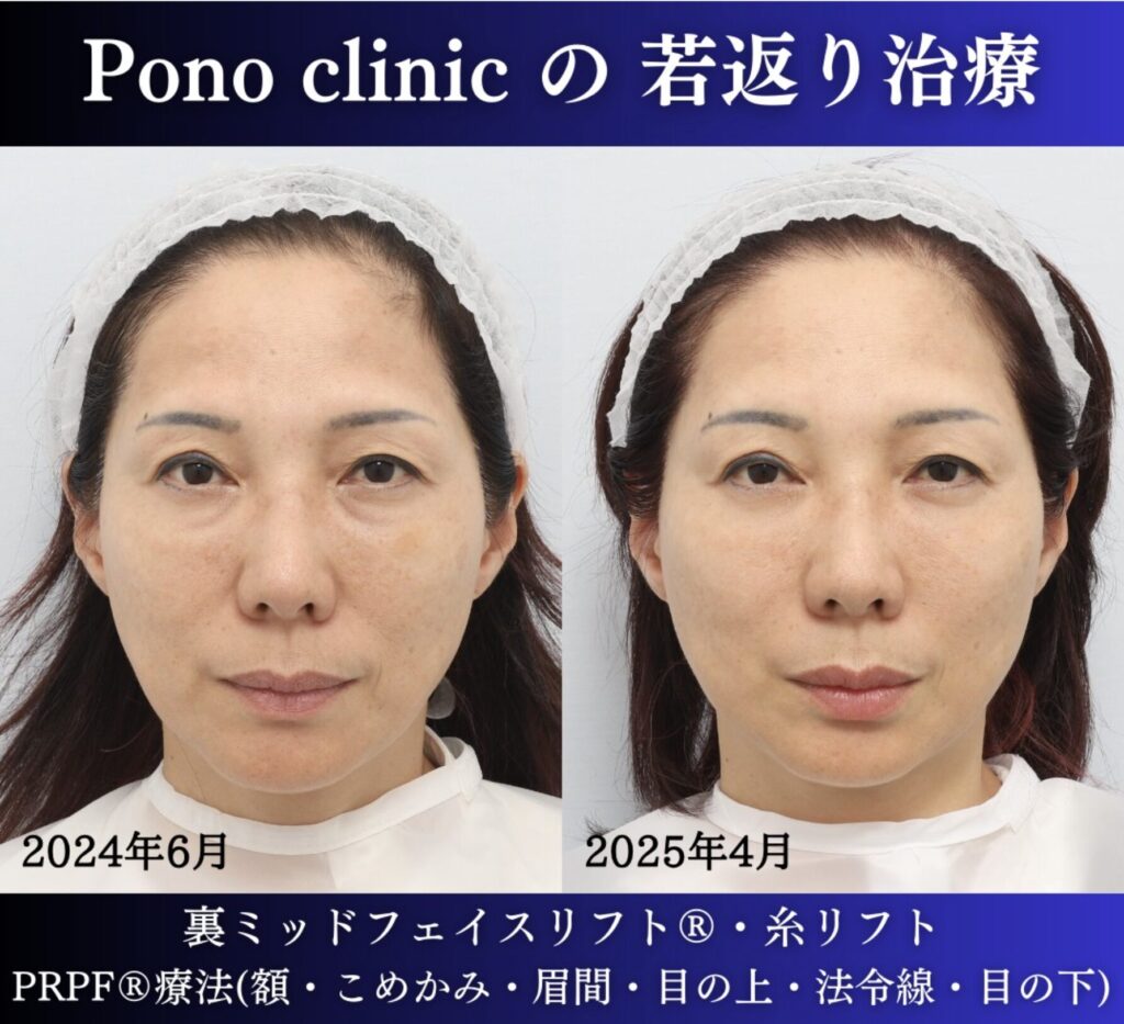 50代女性の症例、目の下のクマ、糸リフト、PRPF療法、若返り治療 (5)