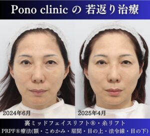 50代女性の症例、目の下のクマ、糸リフト、PRPF療法、若返り治療 (5)