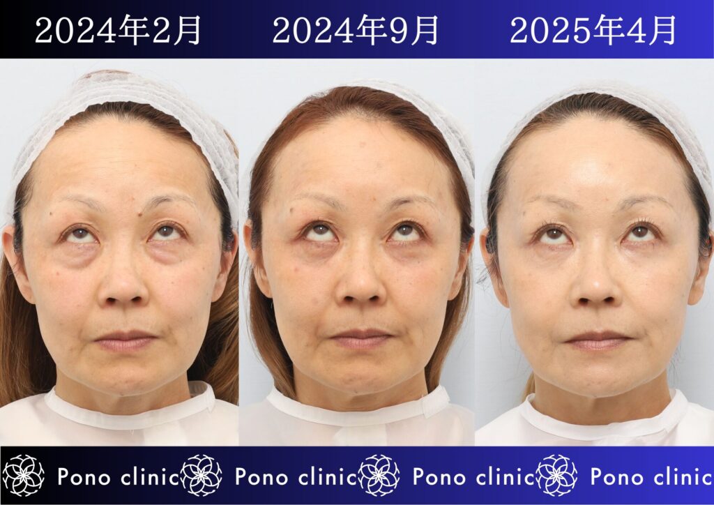 目の下のクマ治療、裏ミッドフェイスリフト®、PRPF®療法、50代の症例 (3)