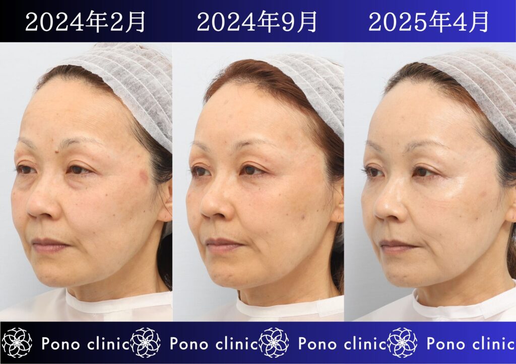目の下のクマ治療、裏ミッドフェイスリフト®、PRPF®療法、50代の症例 (1)