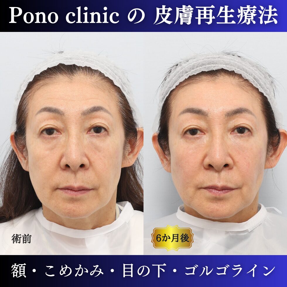 60代女性の症例、PRP注射、目の下のクマ、額形成