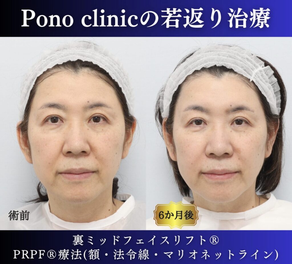 60代女性の症例、アンチエイジング治療、目の下のクマ取り、裏ハムラ (7)