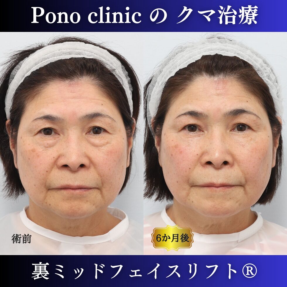 目の下のたるみ、クマ取り、裏ミッドフェイスリフト、60代女性の症例