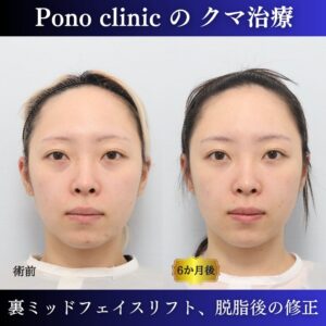 20代女性の症例、脱脂後の修正、裏ハムラ、目の下のクマ取り
