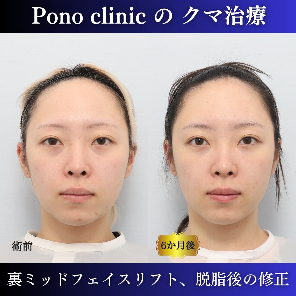 20代女性の症例、脱脂後の修正、裏ハムラ、目の下のクマ取り