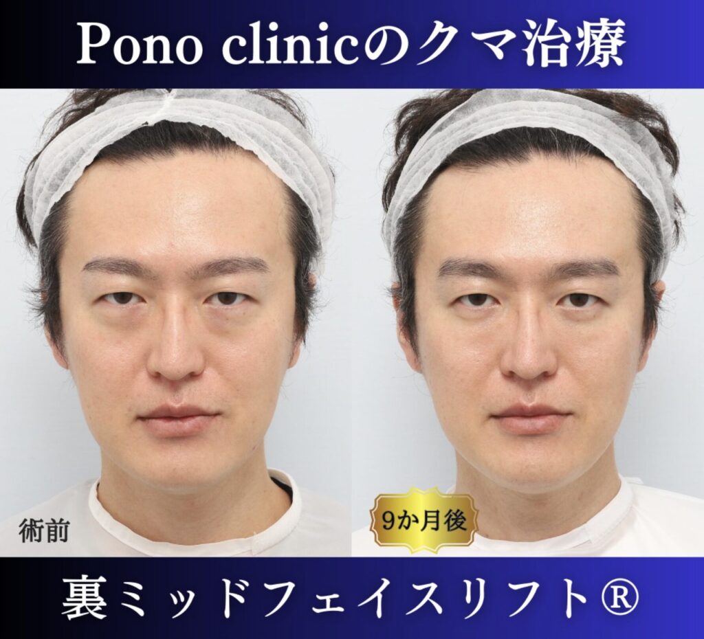 30代男性の症例、裏ハムラ法、目の下のクマ取り (8)