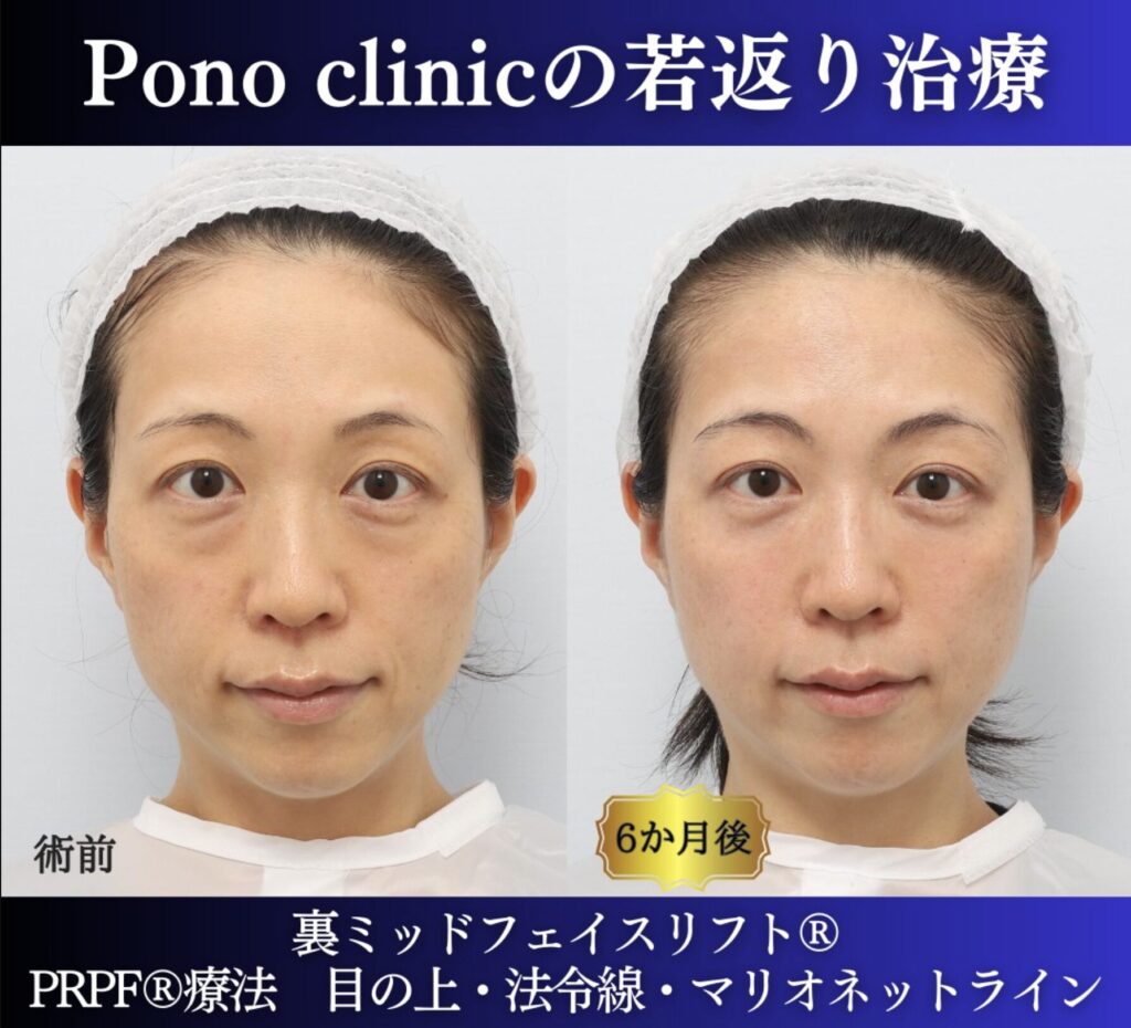 30代の症例、若返り治療PRP注射、目の下のクマ取り、裏ハムラ法 (8)