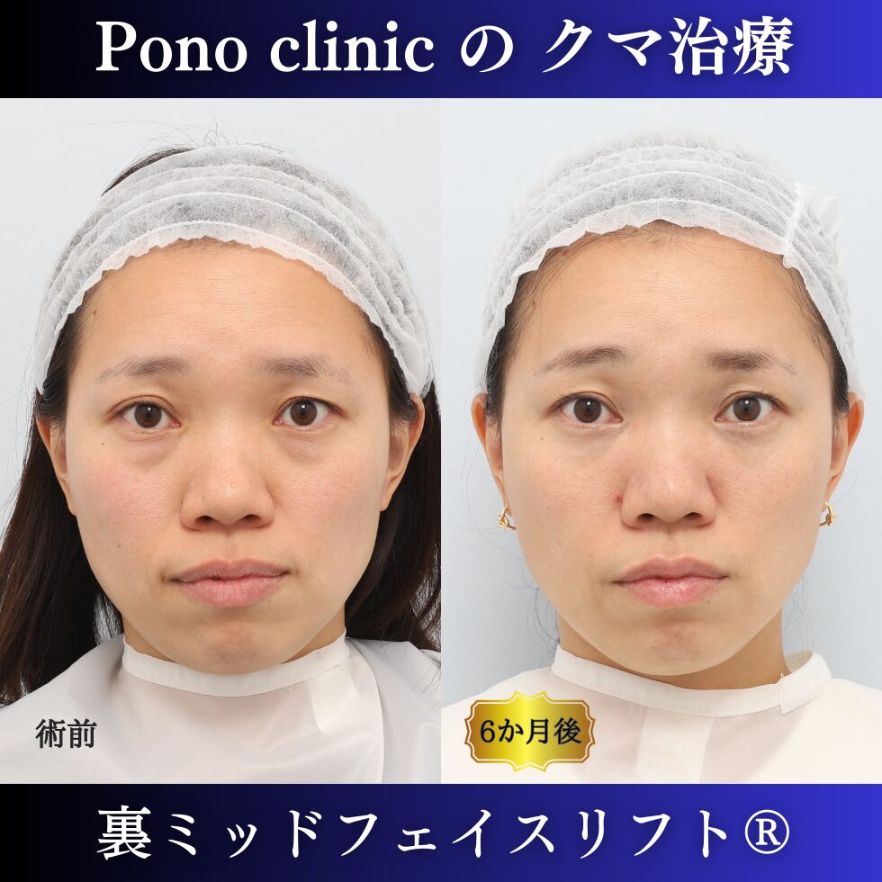 30代女性の症例、目の下のクマ取り、裏ハムラ