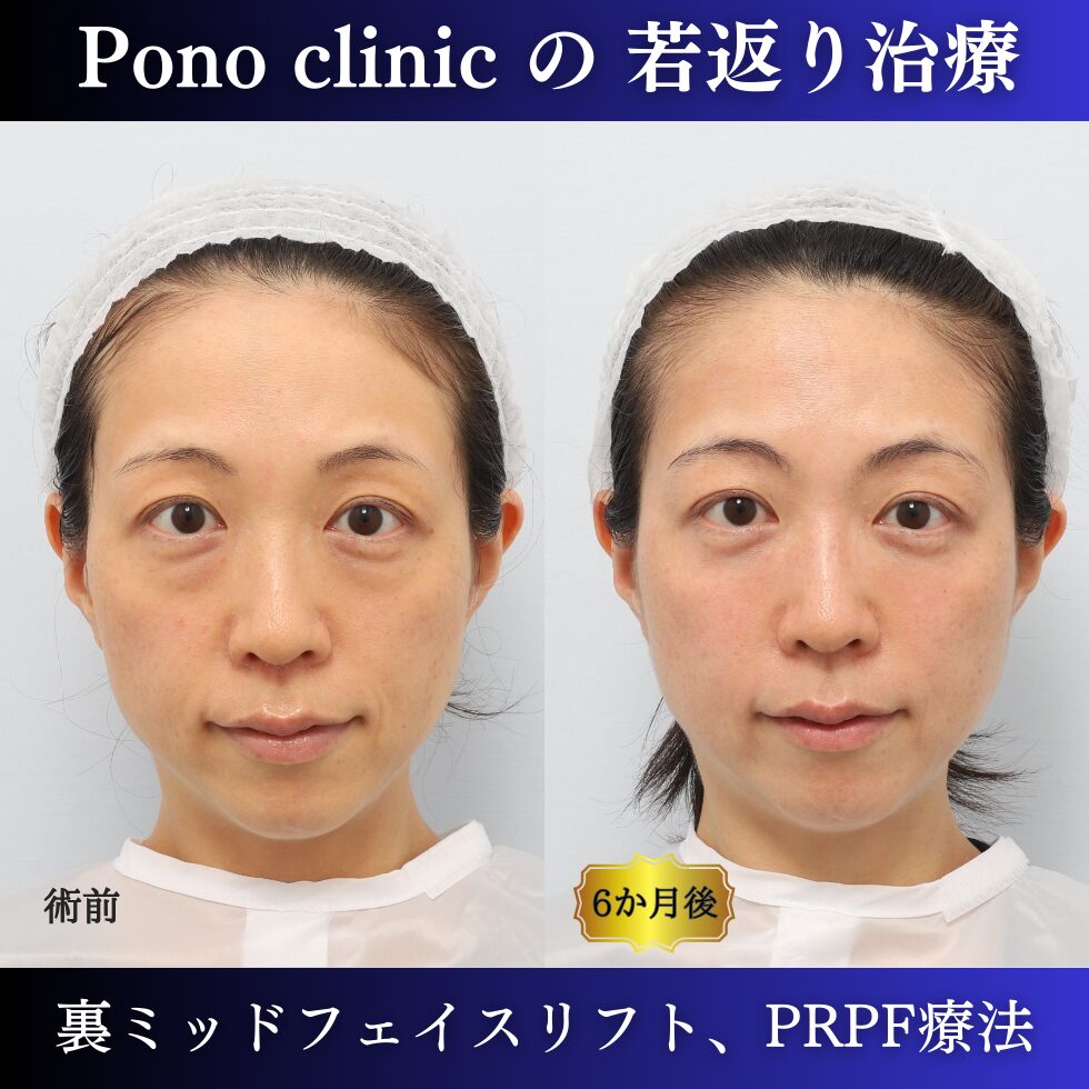 0代の症例、若返り治療PRP注射、目の下のクマ取り、裏ハムラ法