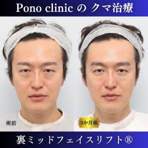 40代男性の症例、裏ハムラ法、目の下のクマ取り
