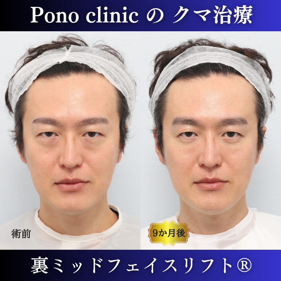 40代男性の症例、裏ハムラ法、目の下のクマ取り