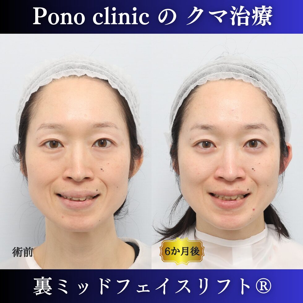 目の下のクマ取り、ハムラ法、裏ミッドフェイスリフト、40代女性の症例