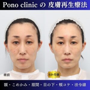 40代女性の症例、PRP注射、若返り治療