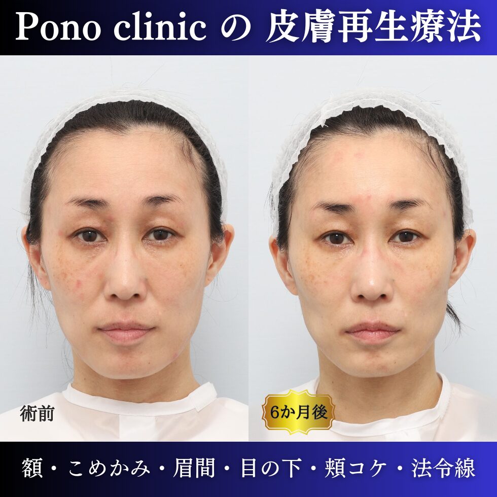 40代女性の症例、PRP注射、若返り治療