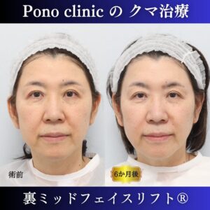 60代女性の症例、アンチエイジング治療、目の下のクマ取り、裏ハムラ