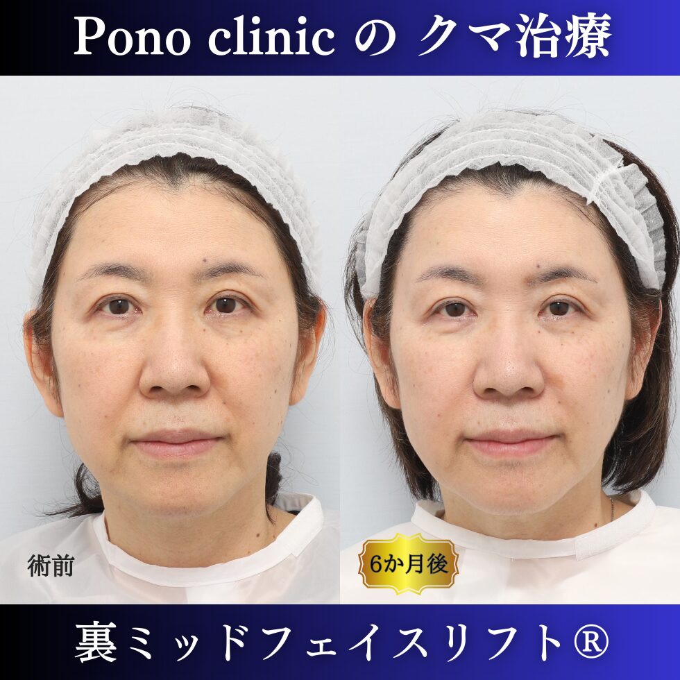 60代女性の症例、アンチエイジング治療、目の下のクマ取り、裏ハムラ