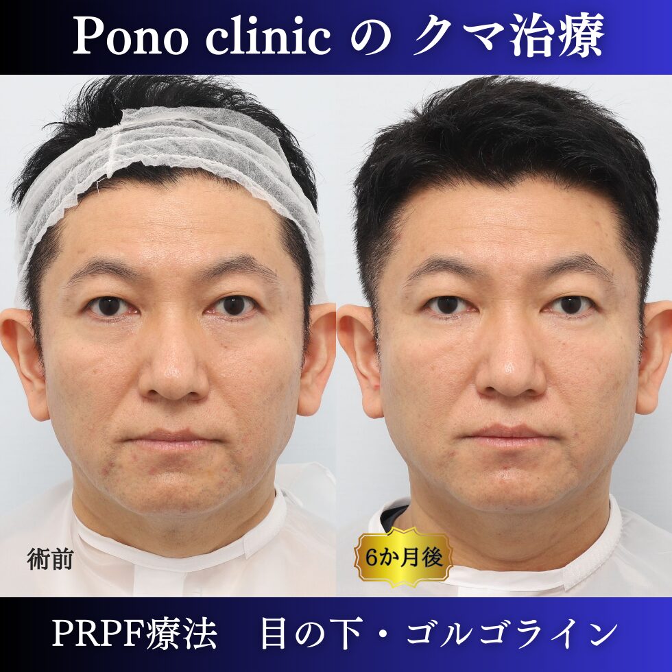 50代男性の症例、目の下のクマ改善、PRP注射