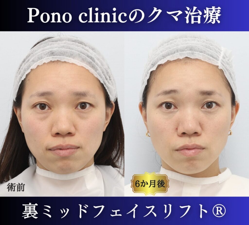 30代女性の症例、目の下のクマ取り、裏ハムラ (7)