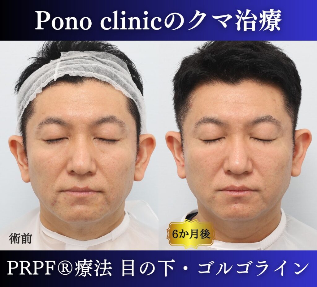 50代男性の症例、目の下のクマ改善、PRP注射 (1)