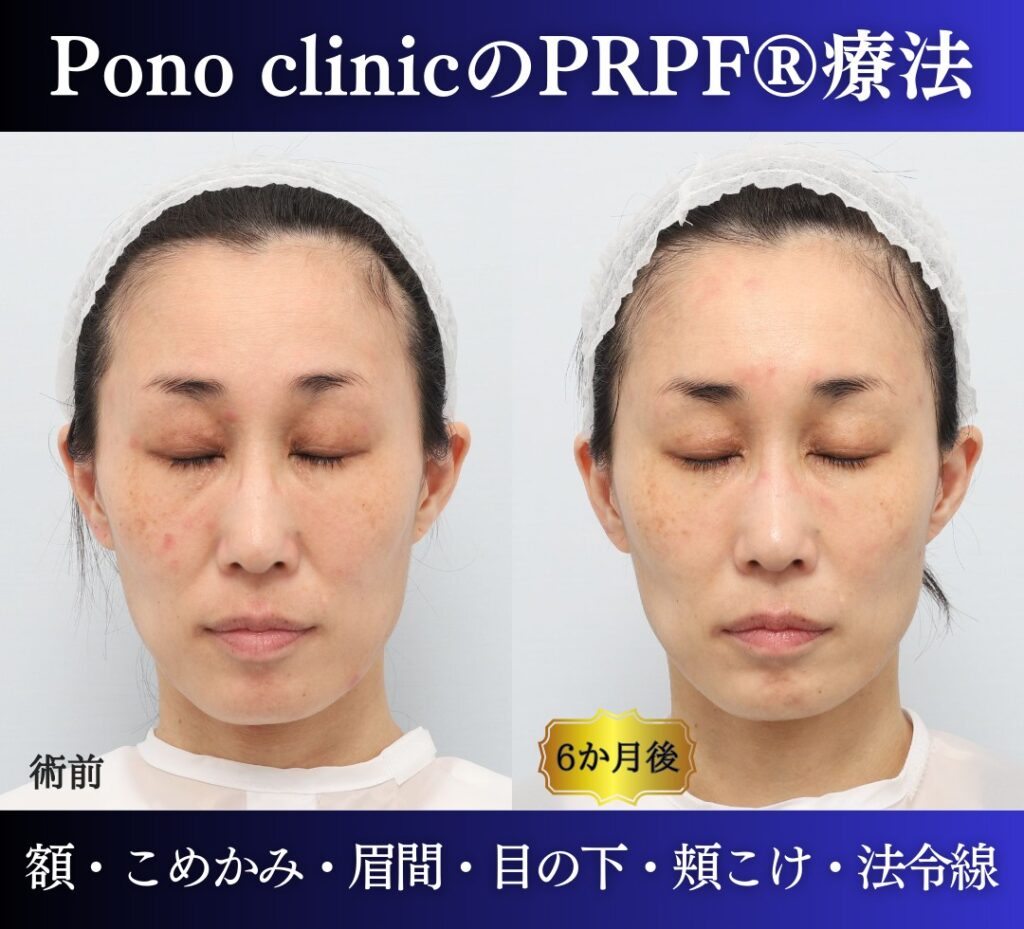 40代女性の症例、PRP注射、若返り治療 (6)