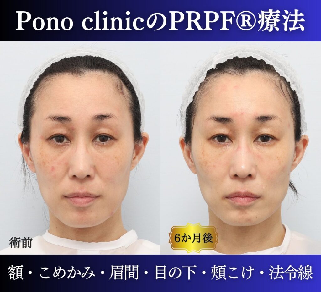 40代女性の症例、PRP注射、若返り治療 (7)