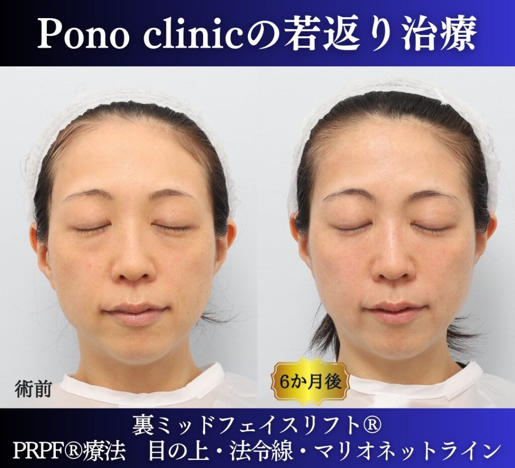 30代の症例、若返り治療PRP注射、目の下のクマ取り、裏ハムラ法 (5)
