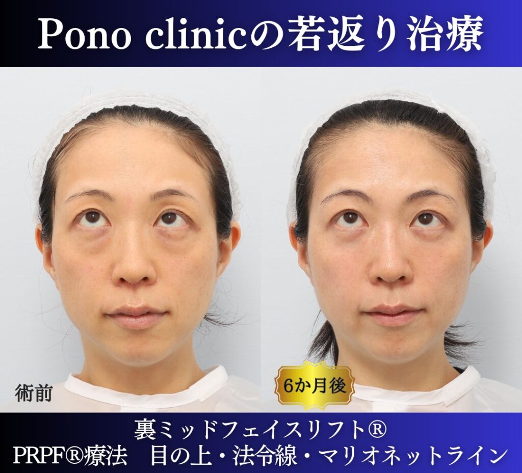 30代の症例、若返り治療PRP注射、目の下のクマ取り、裏ハムラ法 (6)