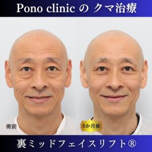 男性のクマ取り手術、裏ミッドフェイスリフト®、50代の症例