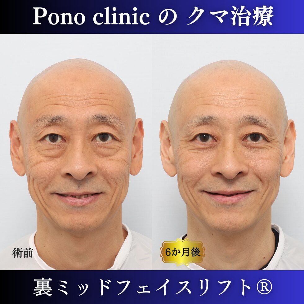 男性のクマ取り手術、裏ミッドフェイスリフト®、50代の症例