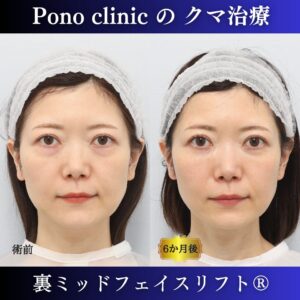 30代女性の症例、目の下のたるみ取り、目の下のクマ取り