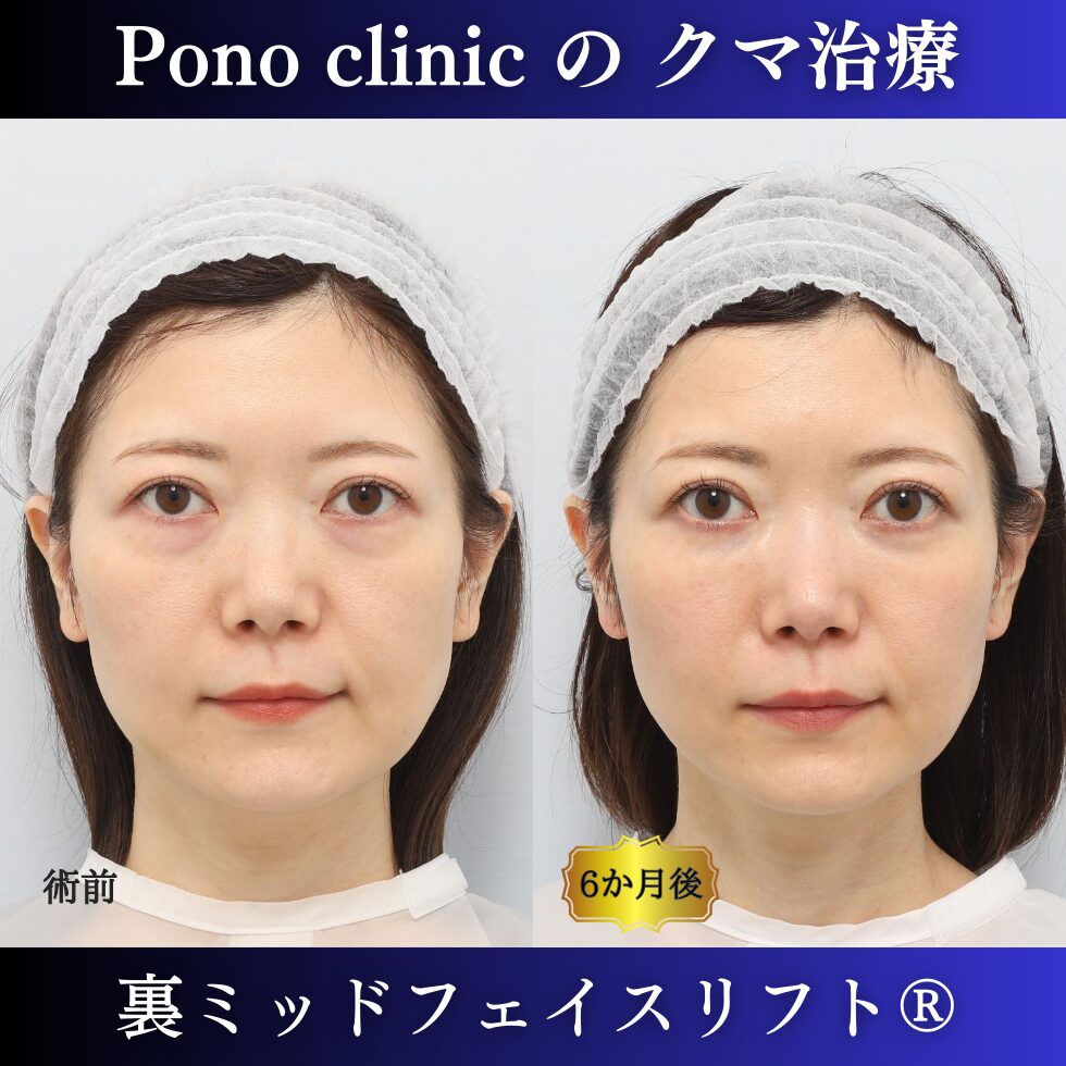 30代女性の症例、目の下のたるみ取り、目の下のクマ取り