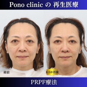 50代女性の症例、しわ取り、目の下のクマ取り、再生注射