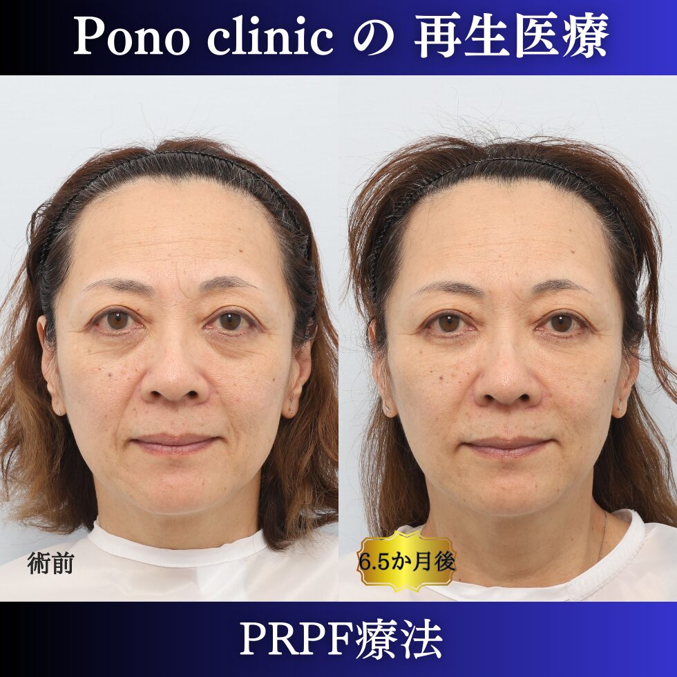50代女性の症例、しわ取り、目の下のクマ取り、再生注射