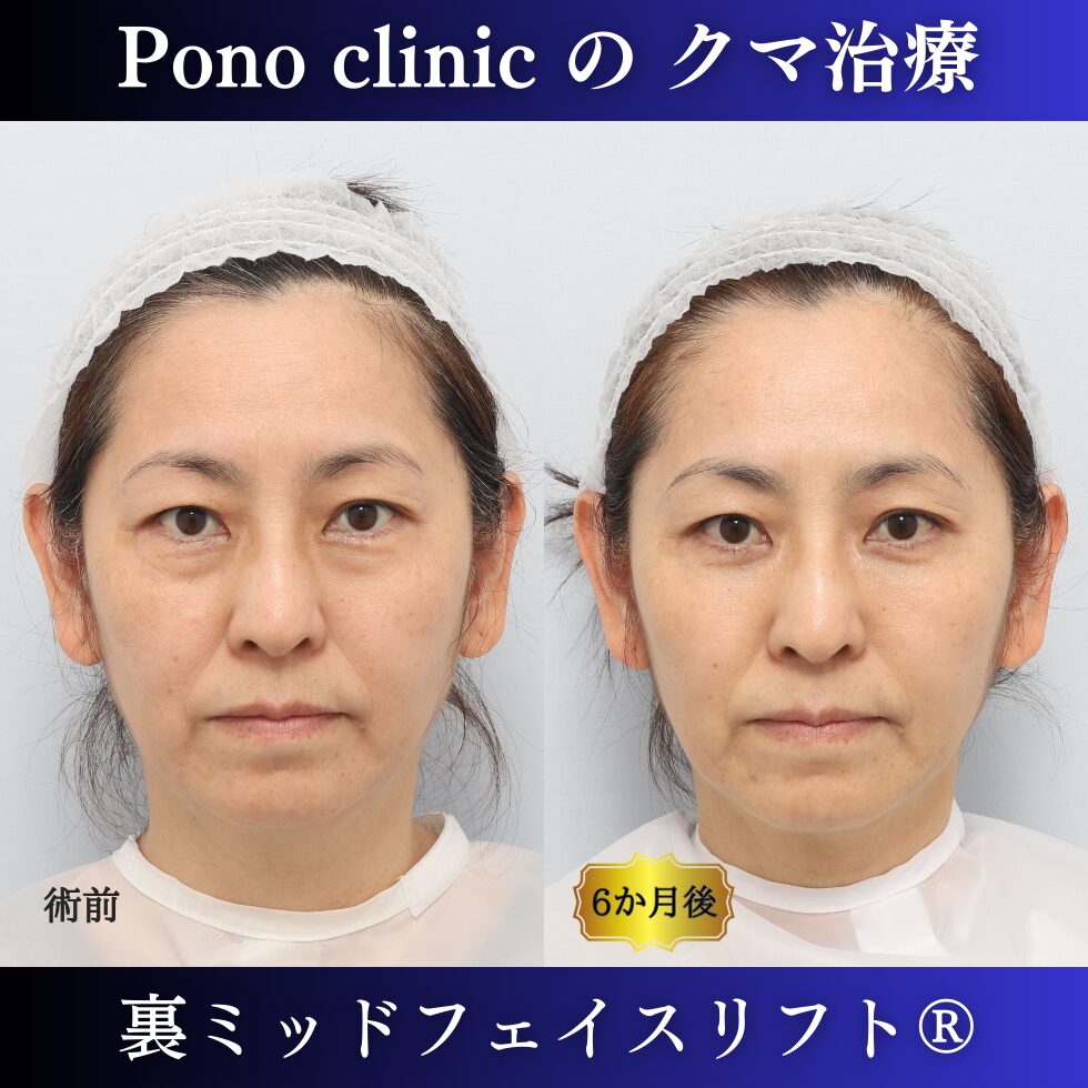 50代女性の症例、目の下のクマ取り、裏ハムラ法、ミッドフェイスリフト