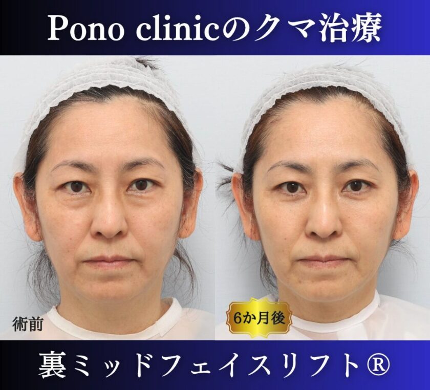 50代女性の症例、目の下のクマ取り、裏ハムラ法、ミッドフェイスリフト (7)