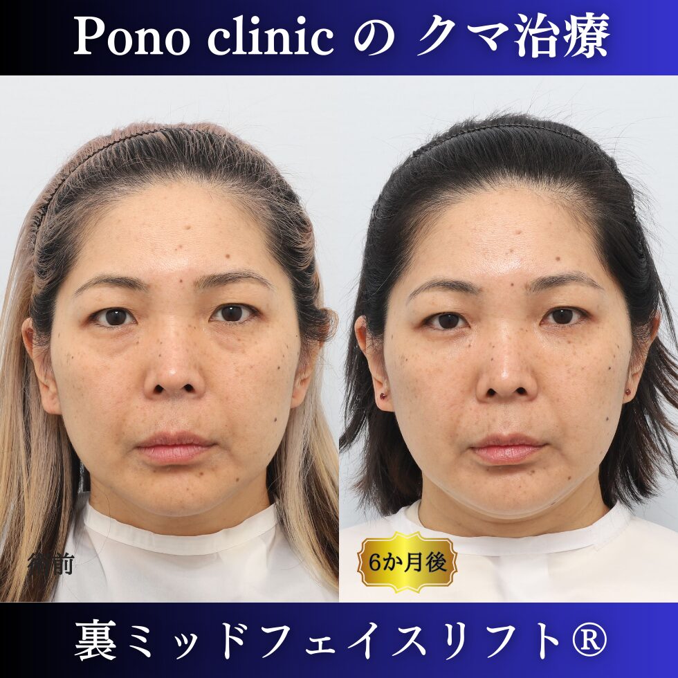 40代女性のクマ治療、目の下のクマ取り、裏ハムラ法、ミッドフェイスリフト