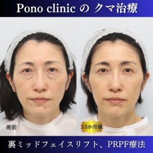 50代女性の症例、アンチエイジング治療、目の下のクマ取り、しわ治療、裏ハムラ法、PRP