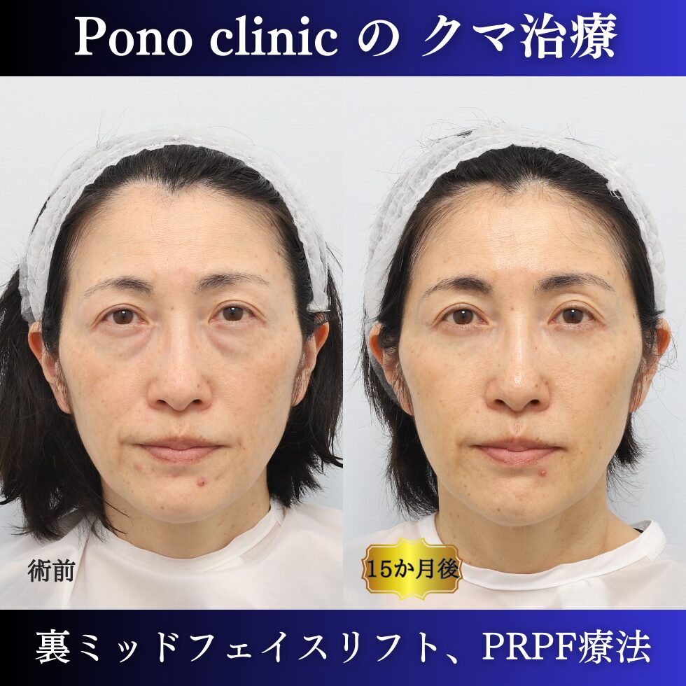 50代女性の症例、アンチエイジング治療、目の下のクマ取り、しわ治療、裏ハムラ法、PRP