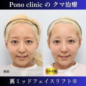 30代女性の症例、 目の下のクマ取り、裏ハムラ法、ミッドフェイスリフト