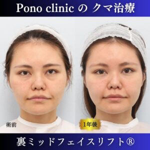 30代女性の症例、目の下のクマ取り、裏ハムラ、裏ミッドフェイスリフト