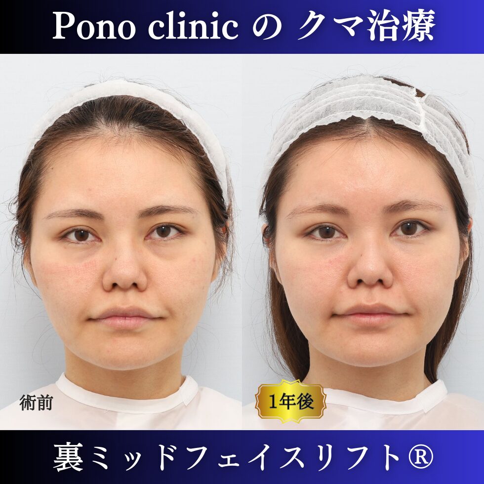 30代女性の症例、目の下のクマ取り、裏ハムラ、裏ミッドフェイスリフト