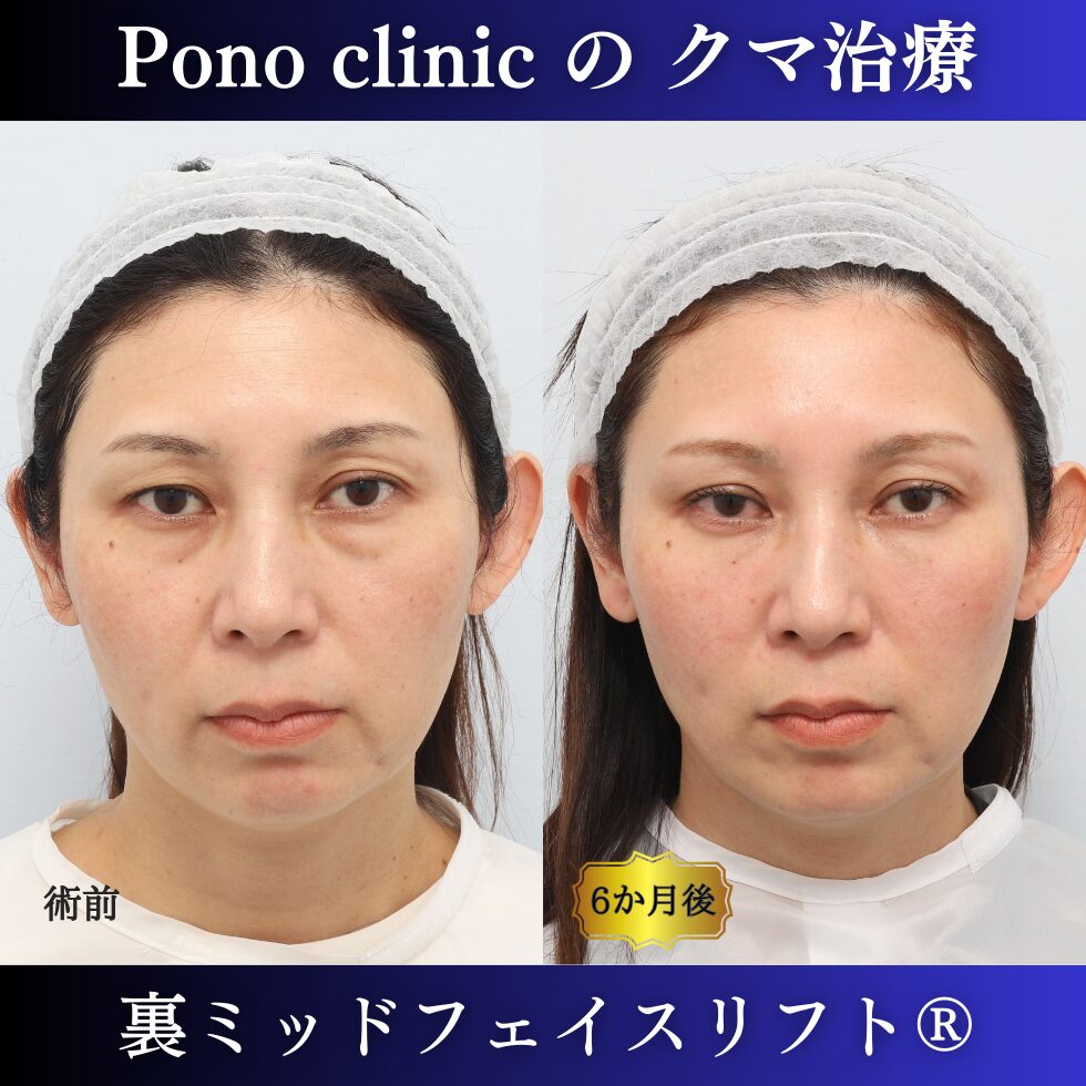 40代女性の症例、目の下のクマ取り、裏ハムラ法、ミッドフェイスリフト、二重埋没法