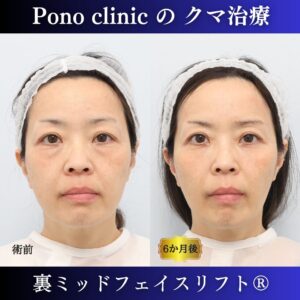 50代女性の症例、目の下のクマ取り、裏ミッドフェイスリフト、裏ハムラ