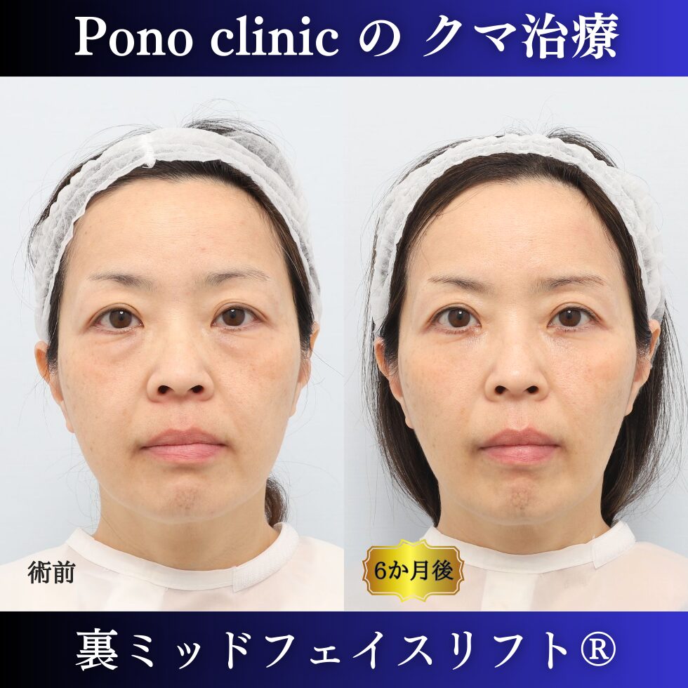 50代女性の症例、目の下のクマ取り、裏ミッドフェイスリフト、裏ハムラ