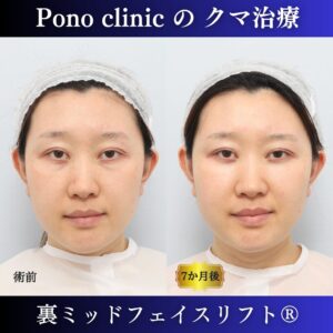 30代女性の症例、目の下のクマ取り、裏ハムラ法、ミッドフェイスリフト