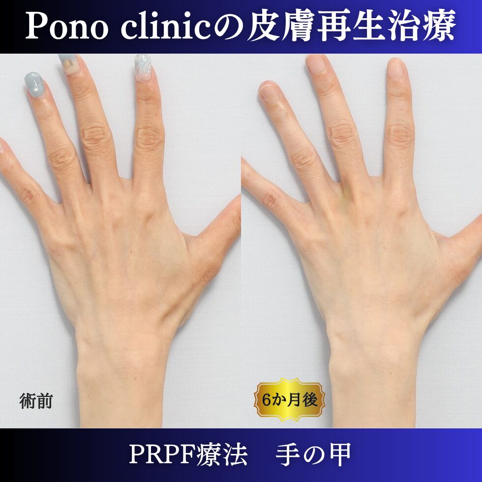 手の甲の若返り、PRPF療法、手の甲のゴツゴツ感